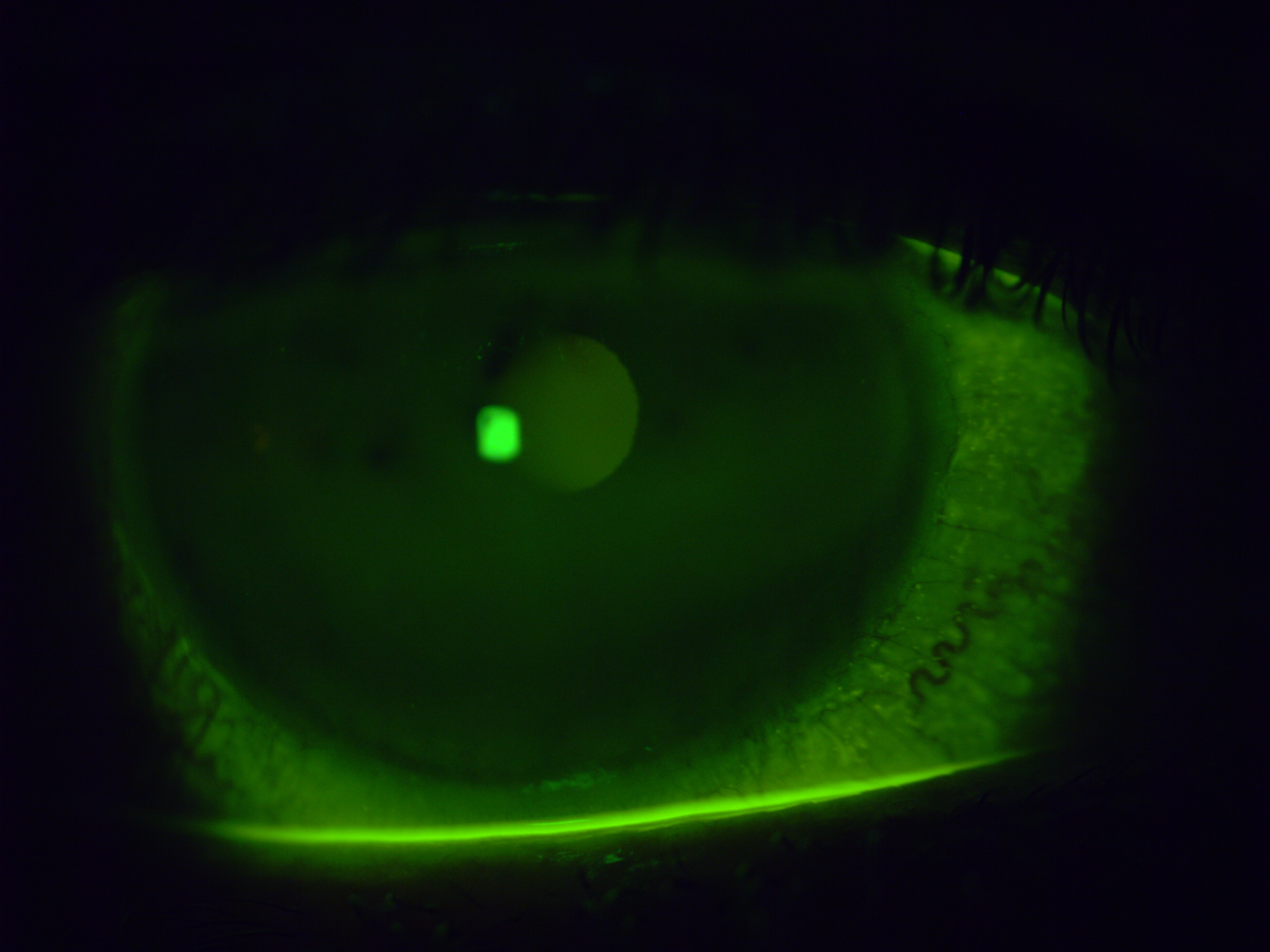 [clinical] One week after Omnilenz removal — the corneal surface is substantially clearer, with the diffuse punctate staining largely resolved compared to presentation