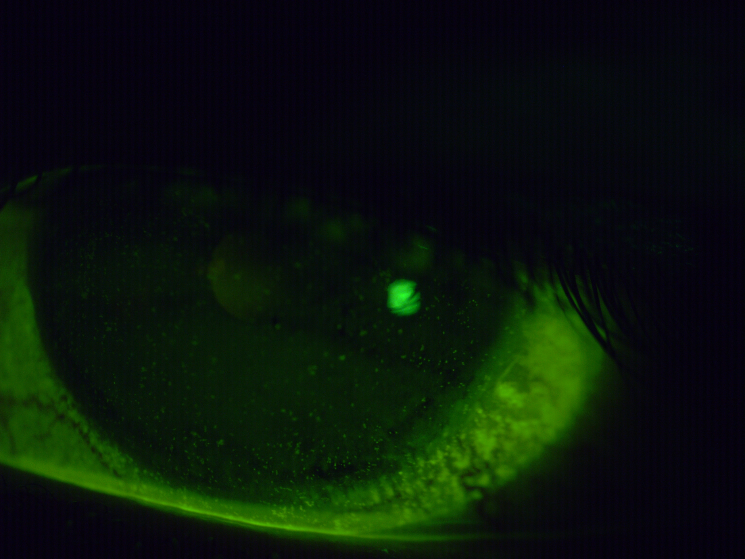 [clinical] Diffuse punctate corneal staining on presentation — widespread epithelial damage visible across the entire corneal surface