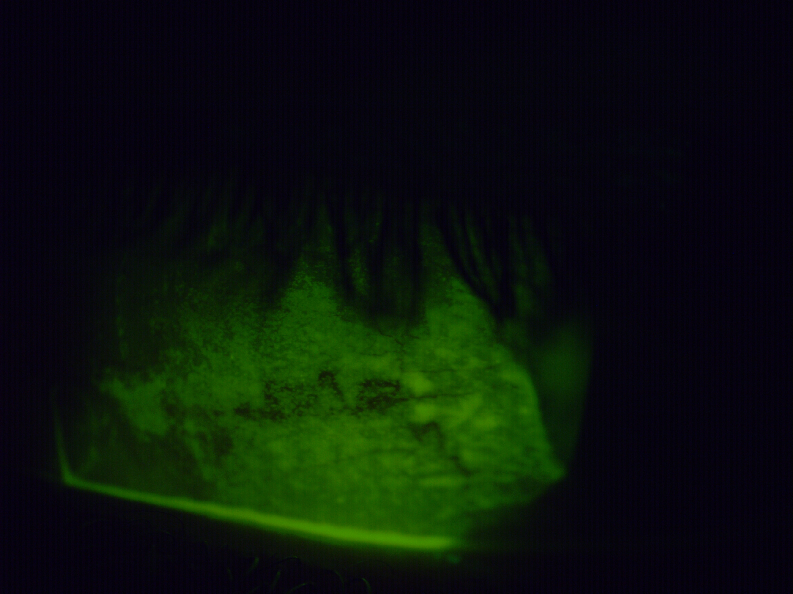 [clinical] Inferior conjunctival staining on presentation — significant epithelial damage with mucous debris along the lower lid margin