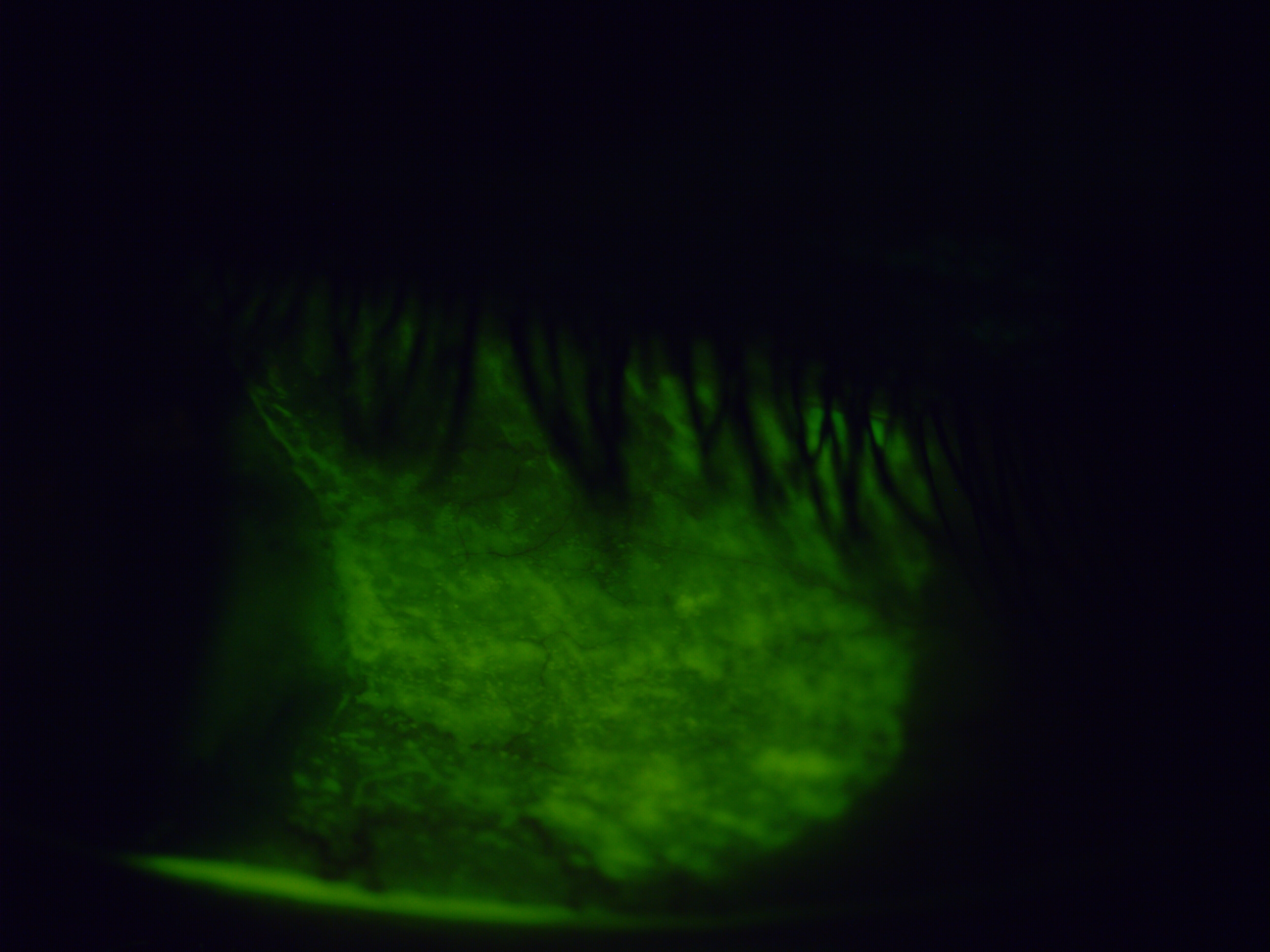 [clinical] Extensive inferior conjunctival staining showing a 'crazy paving' pattern — indicating severe, widespread epithelial surface disruption