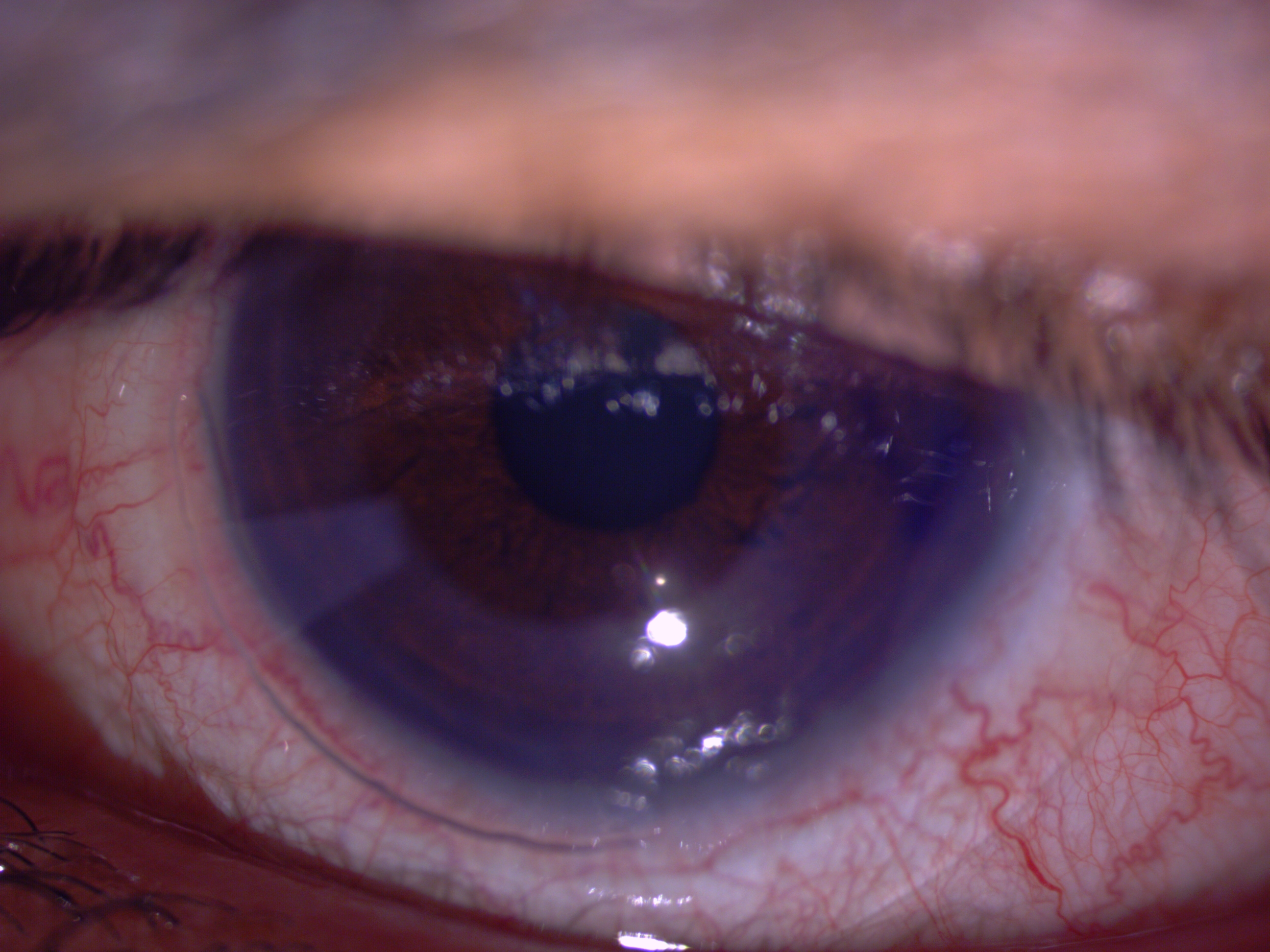[clinical] The Omnilenz in situ — the amniotic membrane contact lens sits on the ocular surface, with conjunctival injection visible indicating the active inflammatory state being treated