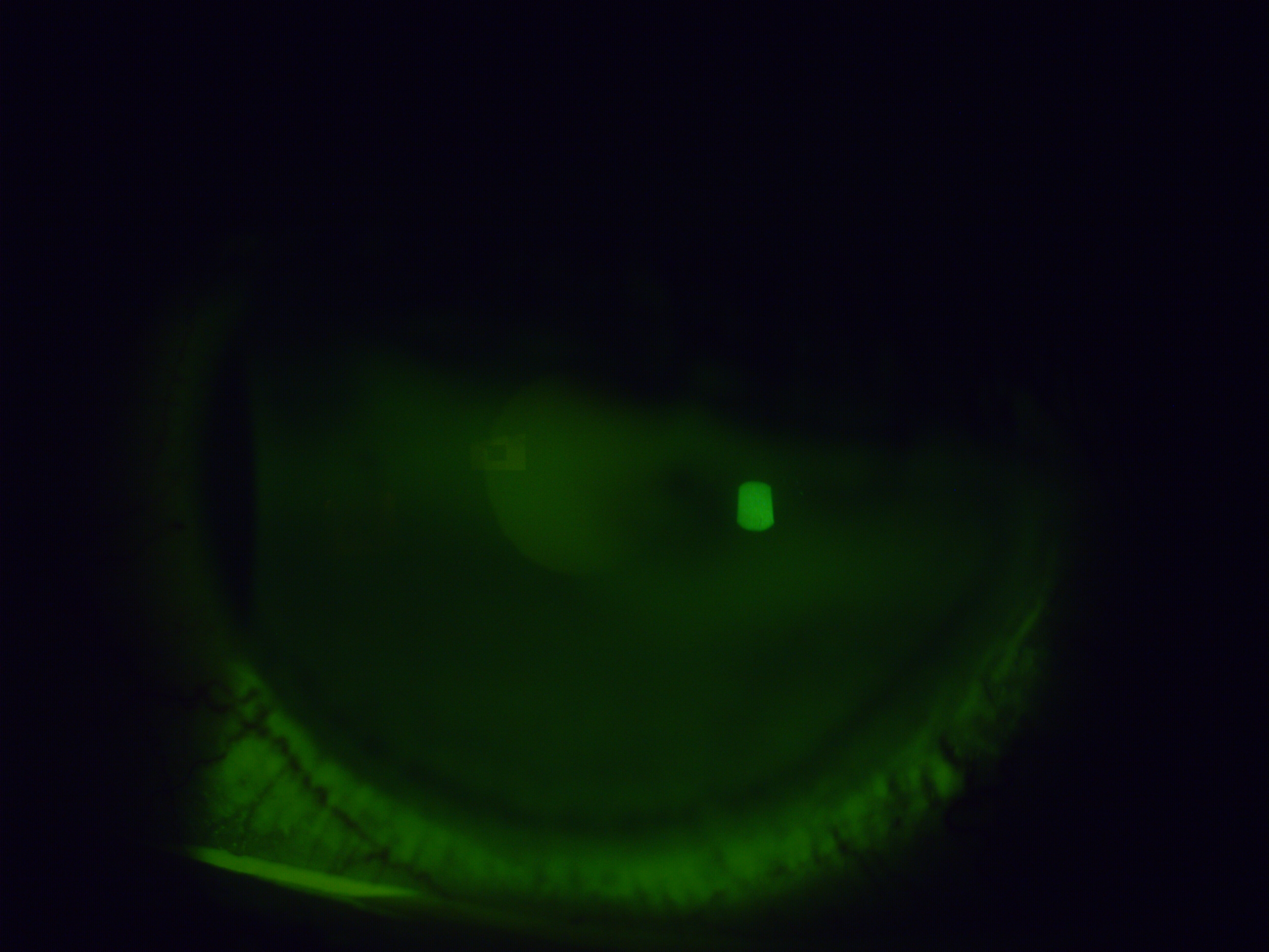 [clinical] Two weeks after stopping all preserved drops — the diffuse corneal staining has reduced considerably, though some inferior staining persists